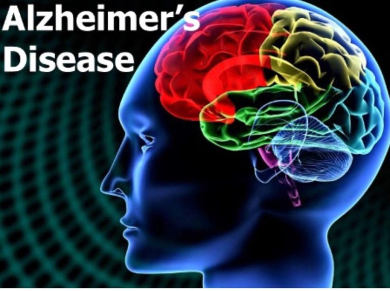 Alzheimer's Image